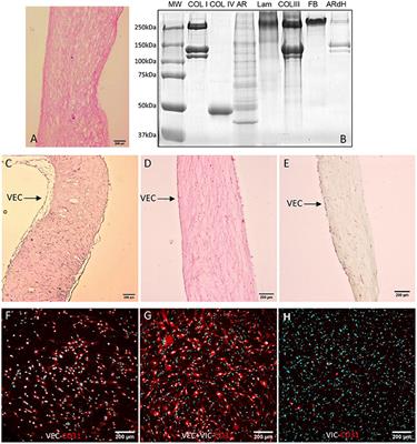 High Glucose Induced Changes in Human VEC Phenotype in a 3D Hydrogel Derived From Cell-Free Native Aortic Root